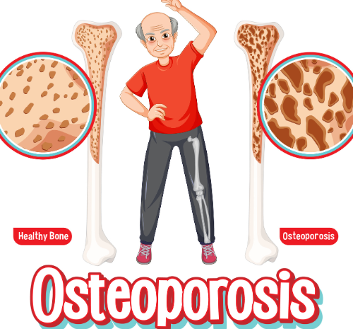  Osteoporosis – A Medical Condition